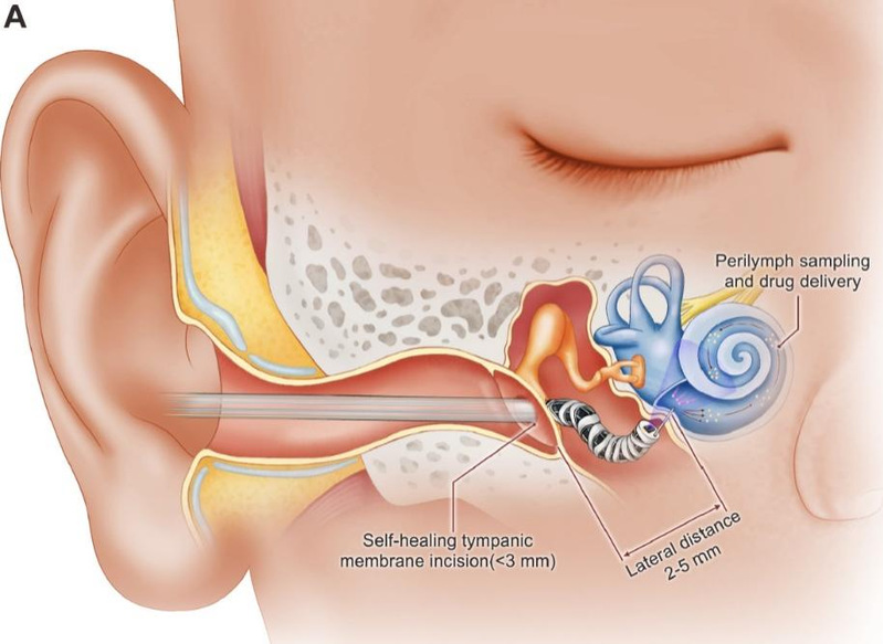 HIT Professor Zhang He achieves new breakthroughs in minimally invasive inner ear surgical robotics